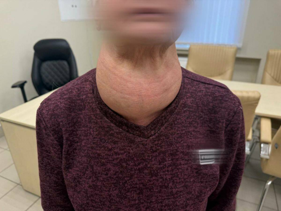 Хирурги РКБ Татарстана удалили у женщины щитовидную железу размером с голову